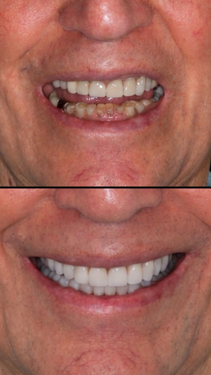 Smile before and after treatment, Las Olas Dentistry patient