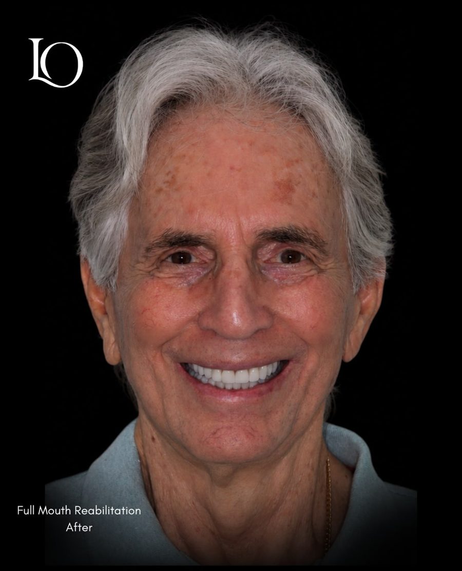 The same patient after full mouth rehabilitation at Las Olas Dentistry