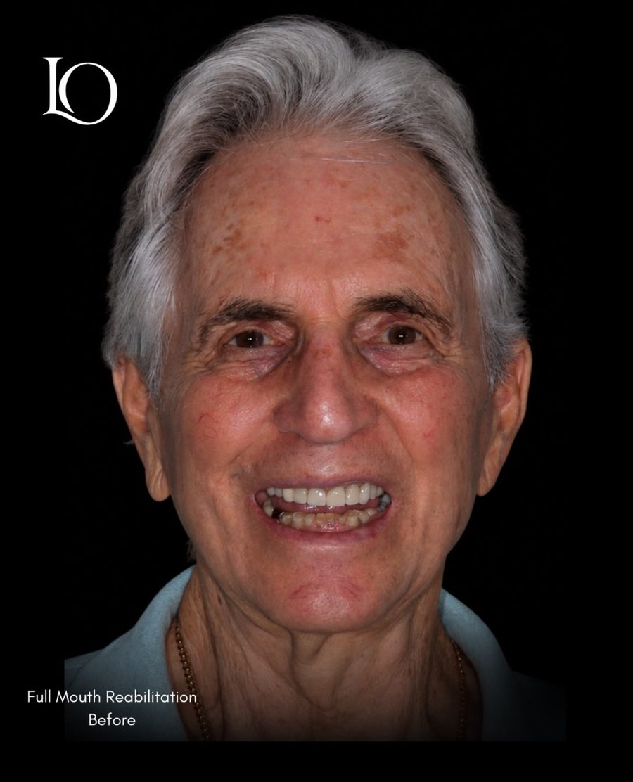 Full mouth rehabilitation patient before treatment