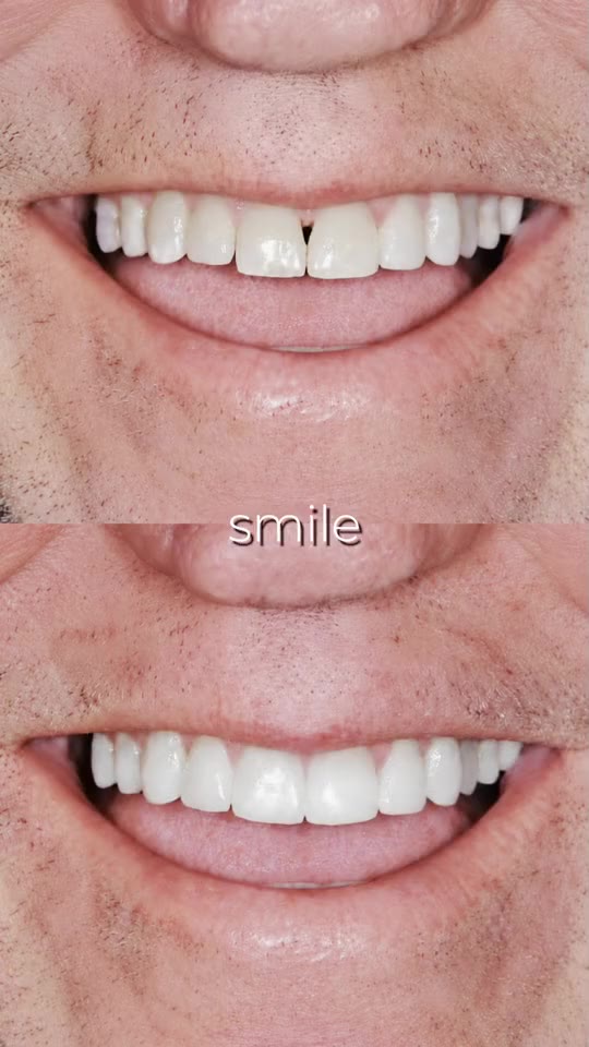 Patient smile before and after treatment at Las Olas Dentistry